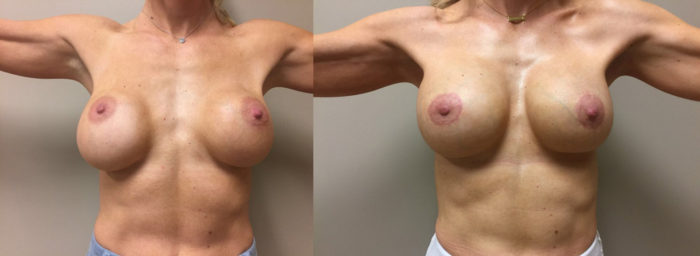 Breast Revision Patient 9 | Dr. Shaun Parson Plastic Surgery, Scottsdale, Arizona