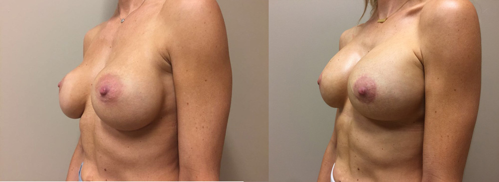 Breast Revision Patient 9 | Dr. Shaun Parson Plastic Surgery, Scottsdale, Arizona