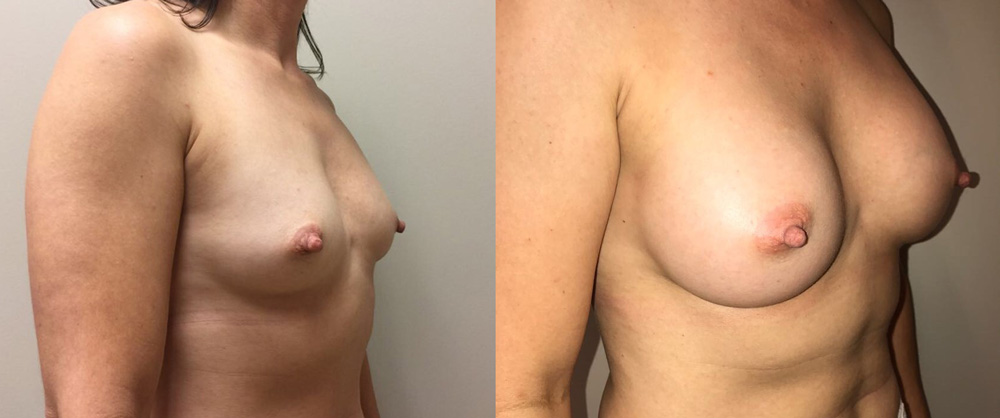 Breast Augmentation Patient 31 | Dr. Shaun Parson Plastic Surgery, Scottsdale, Arizona