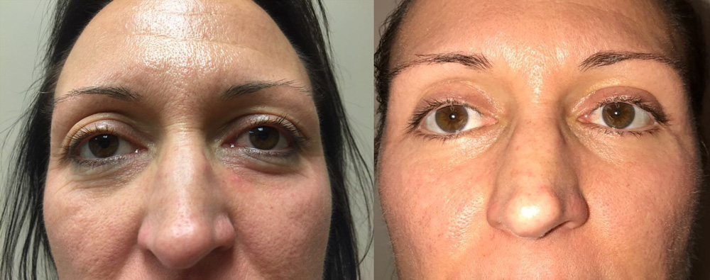 Eyelid Surgery Patient 22 | Dr. Shaun Parson Plastic Surgery, Scottsdale, Arizona