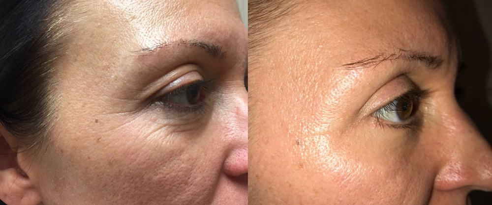 Eyelid Surgery Patient 22 | Dr. Shaun Parson Plastic Surgery, Scottsdale, Arizona