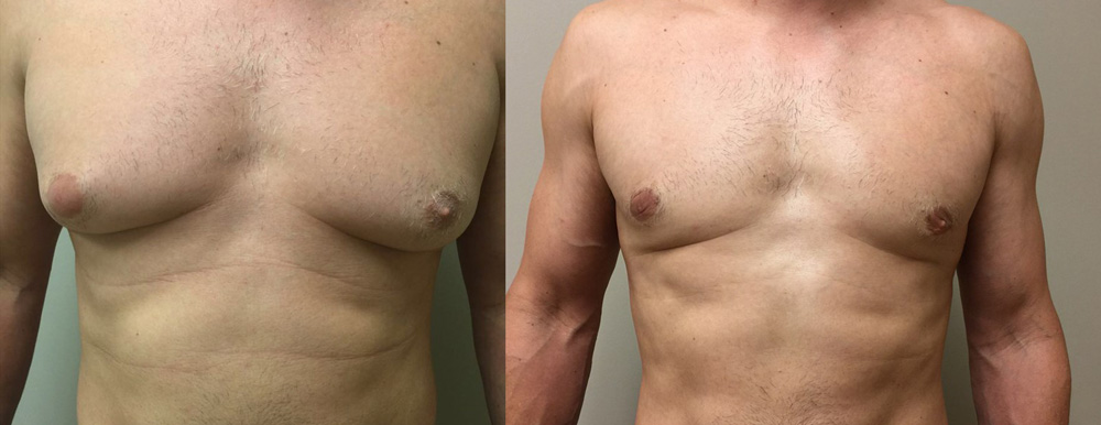 Gynecomastia Patient 14 | Dr. Shaun Parson Plastic Surgery Scottsdale Arizona