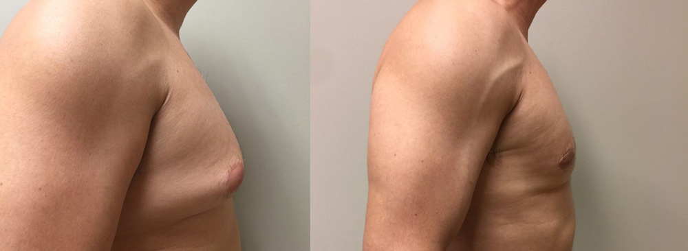 Gynecomastia Patient 14 | Dr. Shaun Parson Plastic Surgery Scottsdale Arizona