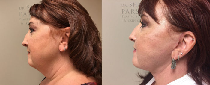 Facelift Patient 18 | Dr. Shaun Parson Plastic Surgery Scottsdale Arizona