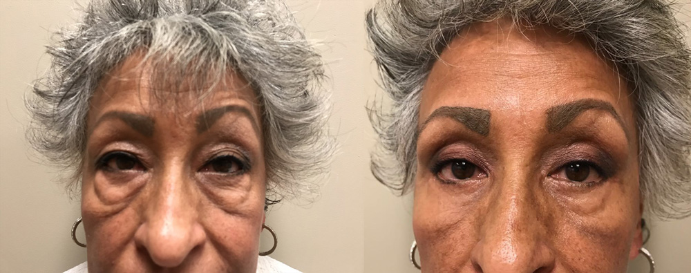 Eyelid Surgery Patient 21 | Dr. Shaun Parson Plastic Surgery, Scottsdale, Arizona