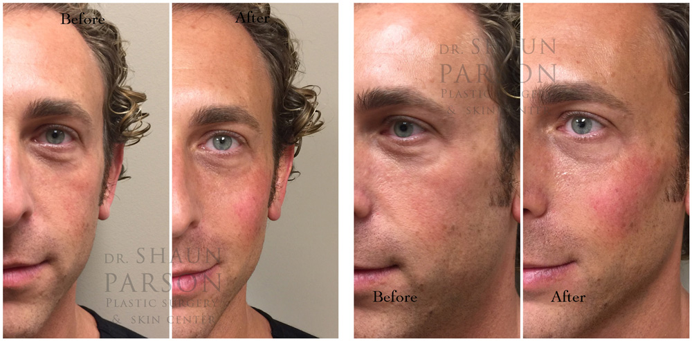 Dermal Filler Patient 6 | Dr. Shaun Parson Plastic Surgery, Scottsdale, Arizona