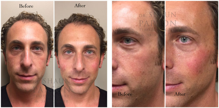 Dermal Filler Patient 6 | Dr. Shaun Parson Plastic Surgery, Scottsdale, Arizona