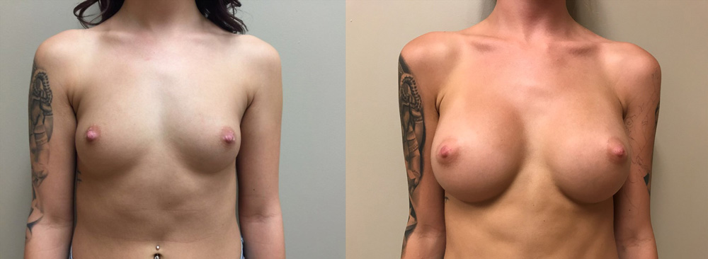 Breast Augmentation Patient 32 Front | Dr. Shaun Parson Plastic Surgery, Scottsdale, Arizona