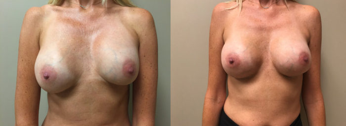 Breast Revision Patient 10 | Scottsdale, AZ