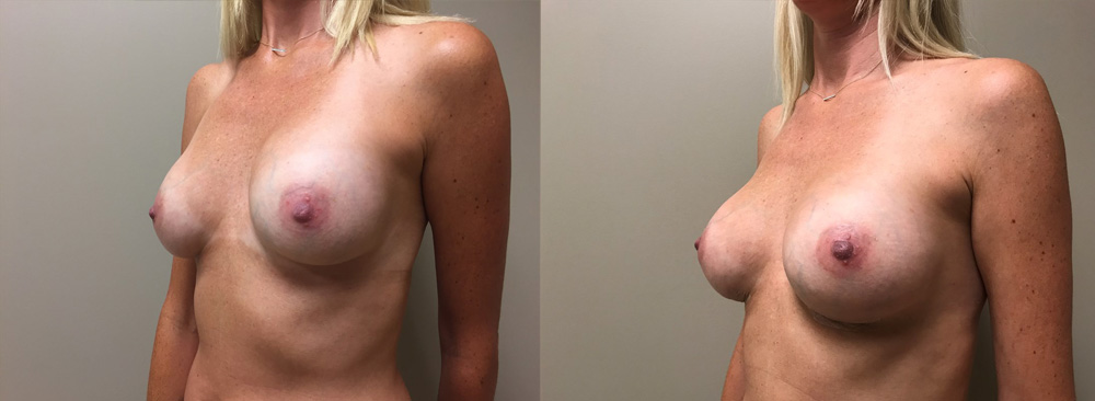 Breast Revision Patient 10 | Scottsdale, AZ