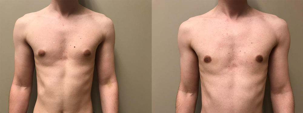 Gynecomastia Patient 15 | Scottsdale, AZ