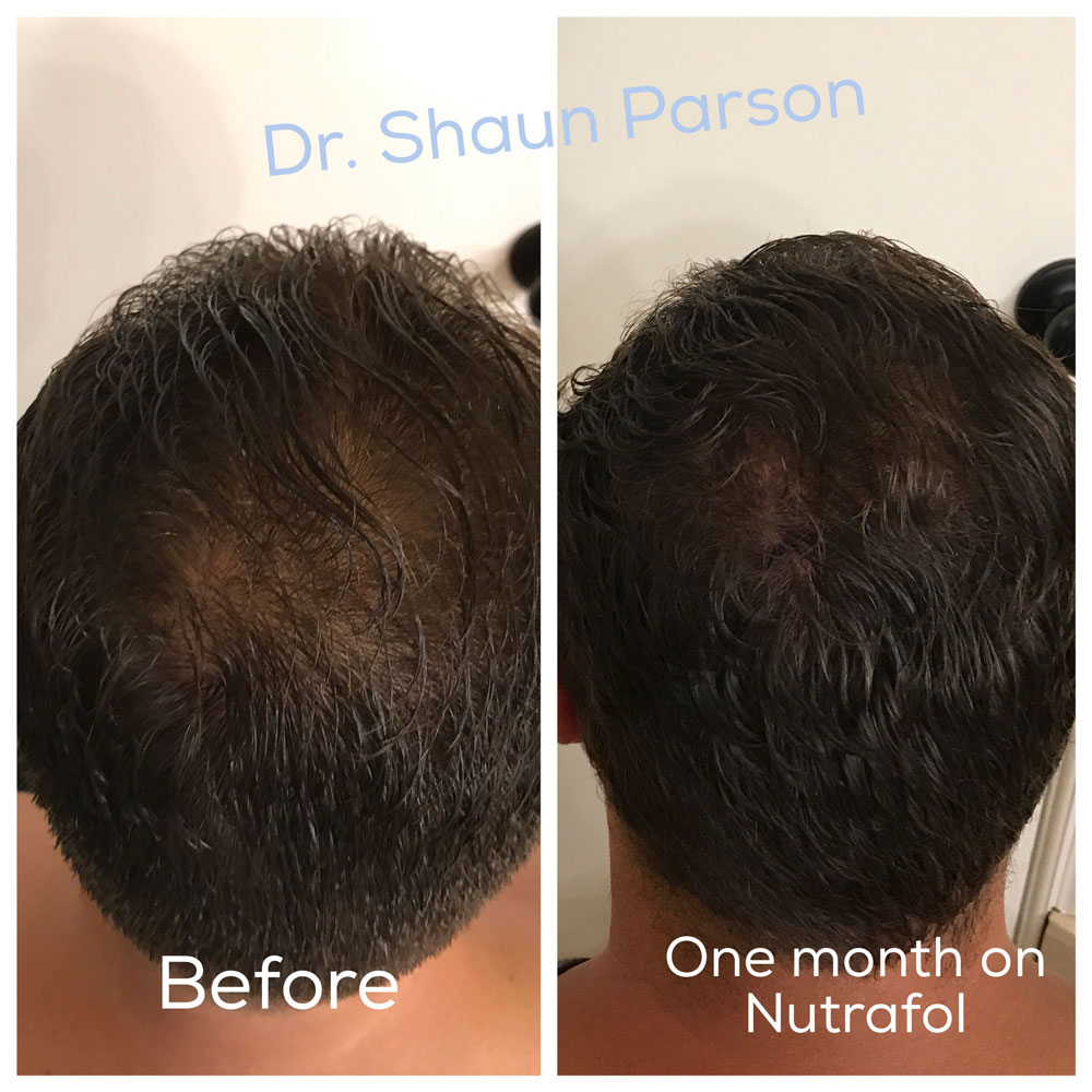 Hair Restoration Patient 2 | Scottsdale, AZ