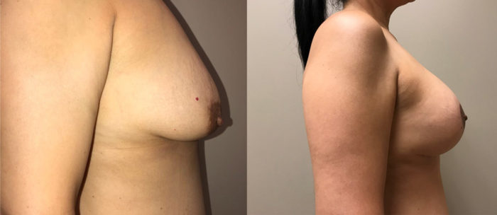 Breast Lift with Augmentation Patient 18 | Scottsdale, AZ