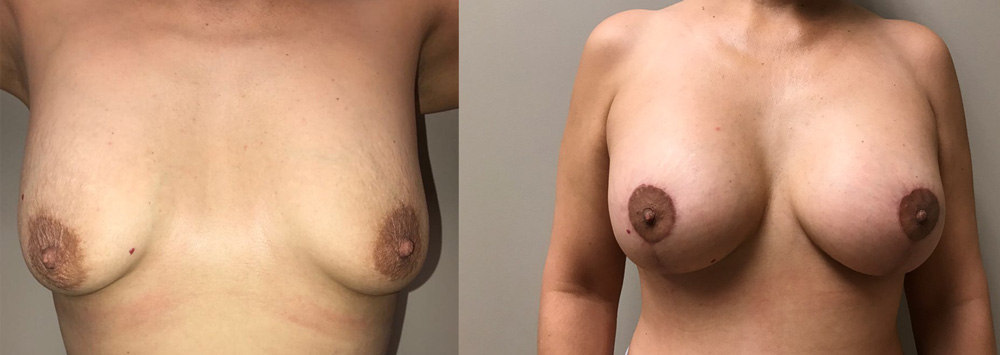 Breast Lift with Augmentation Patient 18 | Scottsdale, AZ