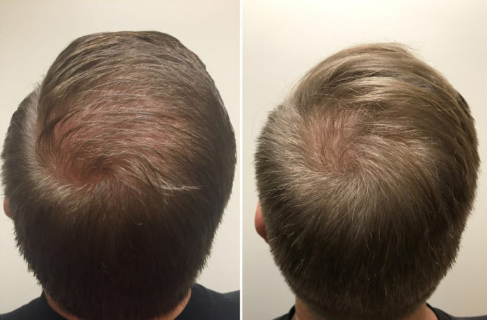 PRP Hair Restoration Patient 1 | Scottsdale, AZ