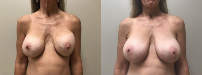 Breast Revision Patient 11 | Scottsdale, AZ | Dr. Shaun Parson