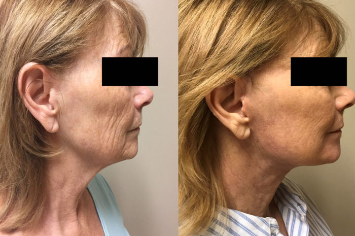 Facelift Patient 19 | Dr. Shaun Parson Scottsdale, AZ