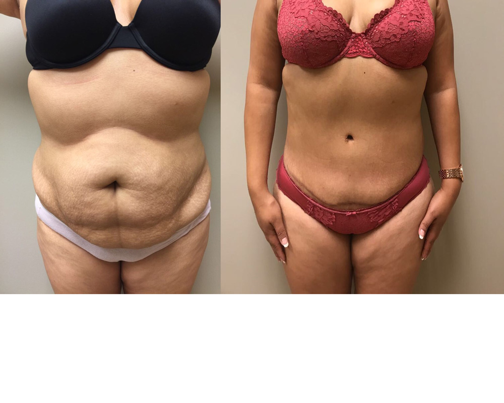 Tummy Tuck Patient 24 | Dr. Shaun Parson, Scottsdale