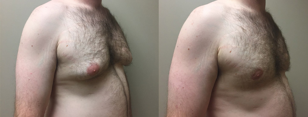 Gynecomastia Patient 16 | Scottsdale, AZ