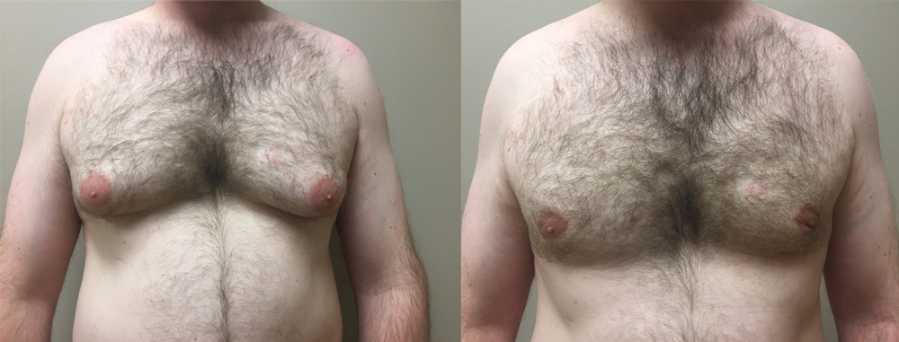 Gynecomastia Patient 16 | Scottsdale, AZ