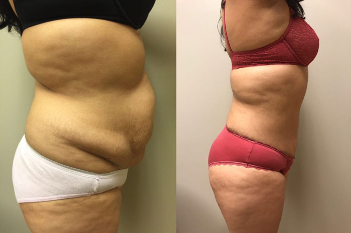 Tummy Tuck Patient 24 | Dr. Shaun Parson, Scottsdale