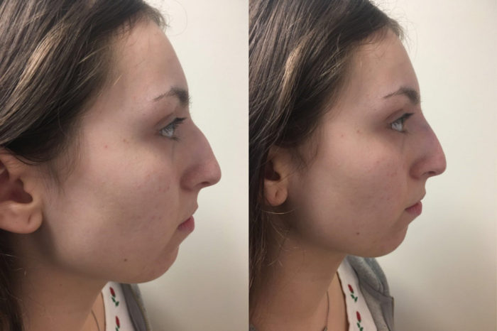 Dermal Filler Patient 8 | Parson Skin Center, Scottsdale