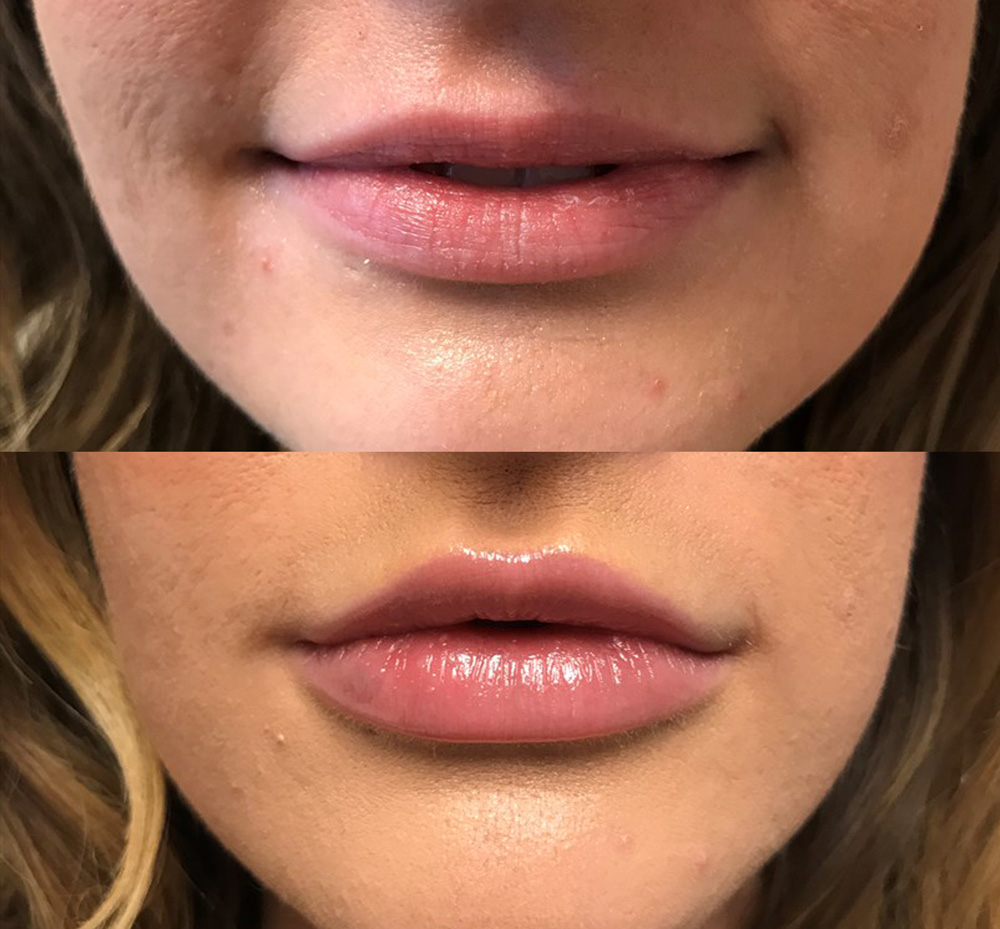 Dermal Filler Patient 9 | Juvederm Lips | Dr. Shaun Parson | Scottsdale