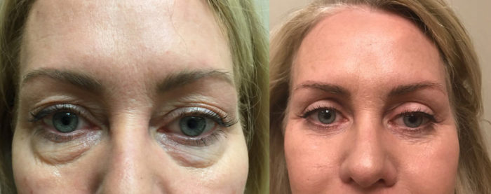 Eyelid Surgery Patient 24 | Dr. Shaun Parson Plastic Surgery, Scottsdale, Arizona