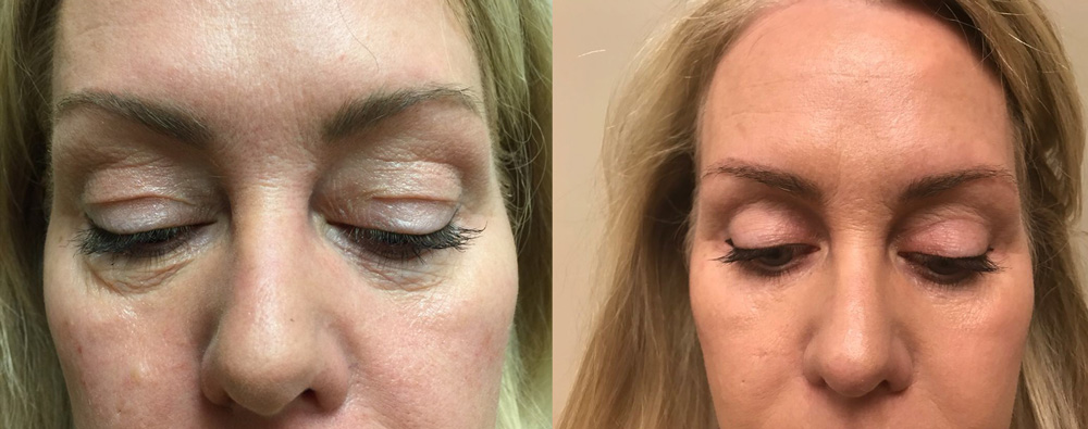 Eyelid Surgery Patient 23 | Dr. Shaun Parson Plastic Surgery, Scottsdale, Arizona