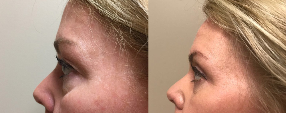 Eyelid Surgery Patient 23 | Dr. Shaun Parson Plastic Surgery, Scottsdale, Arizona