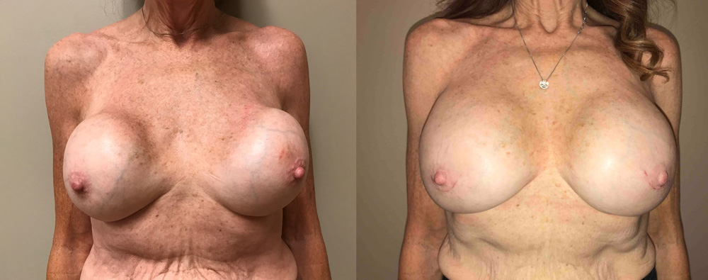 Breast Revision Patient 12 | Scottsdale, AZ | Dr. Shaun Parson