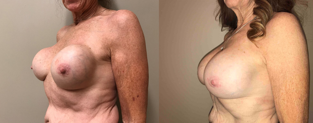 Breast Revision Patient 12 | Scottsdale, AZ | Dr. Shaun Parson