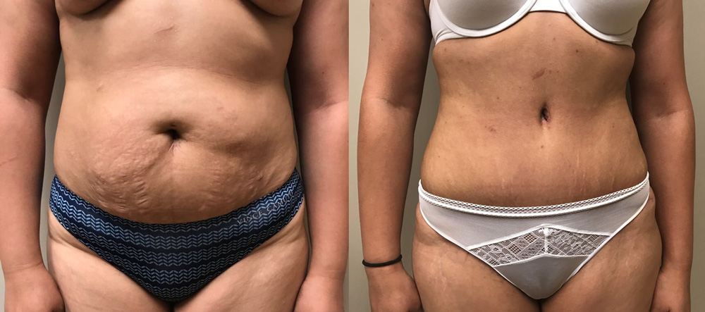 Tummy Tuck Patient 25 | Dr. Shaun Parson, Scottsdale