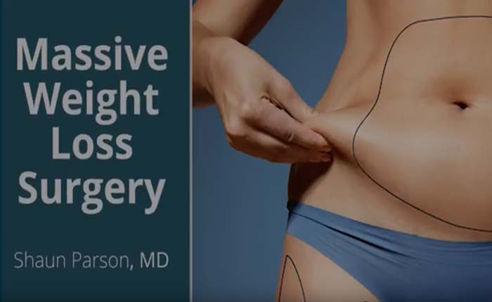 Body Lift Video | Dr. Shaun Parson Plastic Surgery and Skin Center