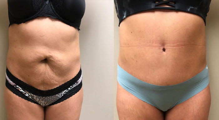 Tummy Tuck Patient 26 | Dr. Shaun Parson, Scottsdale