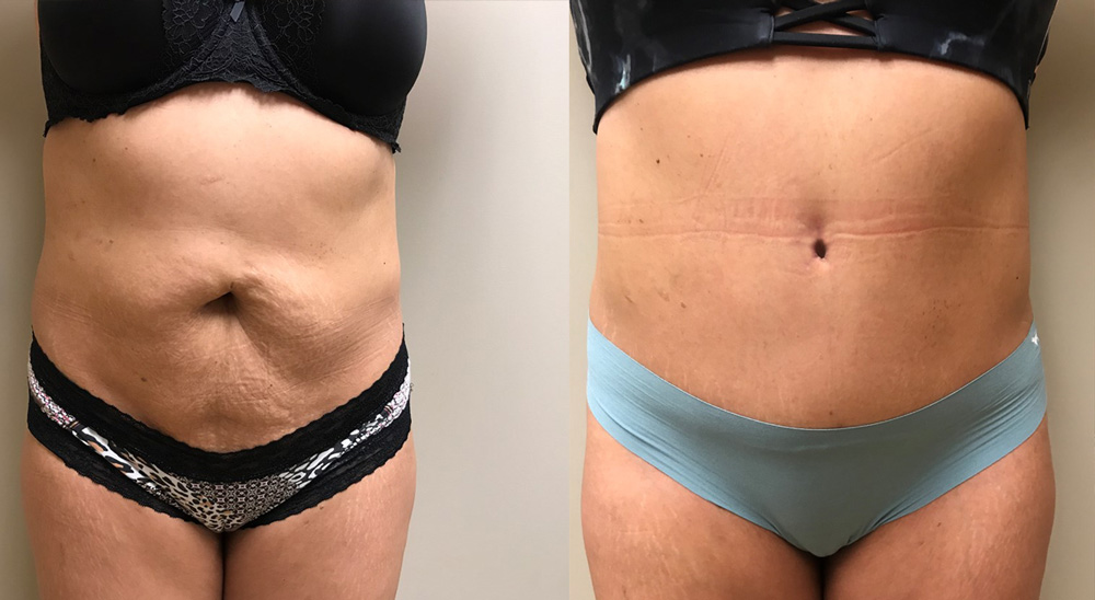 Tummy Tuck Patient 26 | Dr. Shaun Parson, Scottsdale