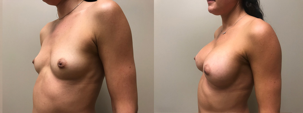 Breast Augmentation Patient 36 | Scottsdale Plastic Surgeon