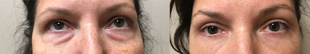 Eyelid Surgery Patient 23 | Dr. Shaun Parson Plastic Surgery, Scottsdale, Arizona