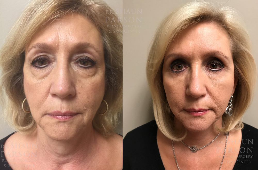 Eyelid Surgery Patient 25 | Dr. Shaun Parson Plastic Surgery, Scottsdale, Arizona