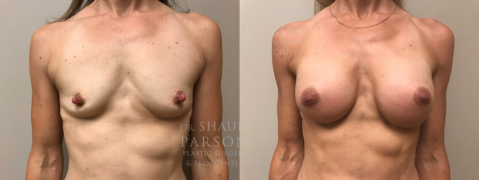 Breast Augmentation Patient 38 | Dr. Shaun Parson Plastic Surgery, Scottsdale, Arizona