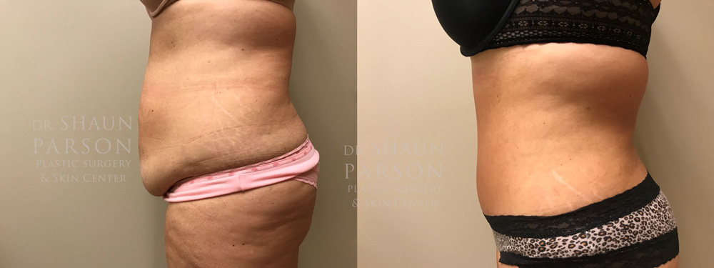 Tummy Tuck Patient 27 | Dr. Shaun Parson, Scottsdale