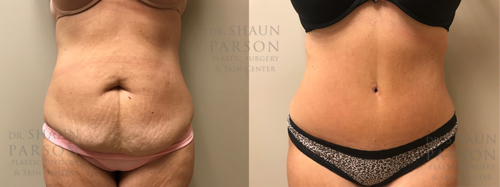 Tummy Tuck Patient 27 | Dr. Shaun Parson, Scottsdale