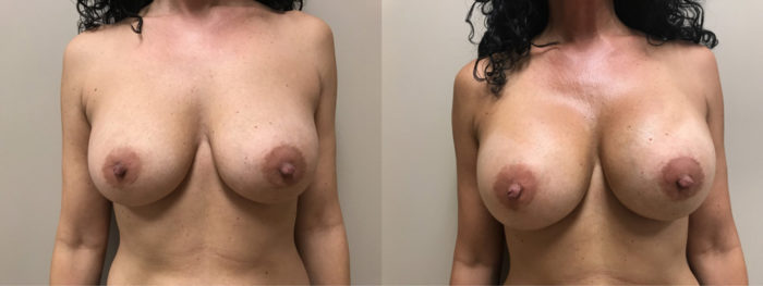 Breast Revision Patient 14 | Dr. Shaun Parson Plastic Surgery & Skin Center