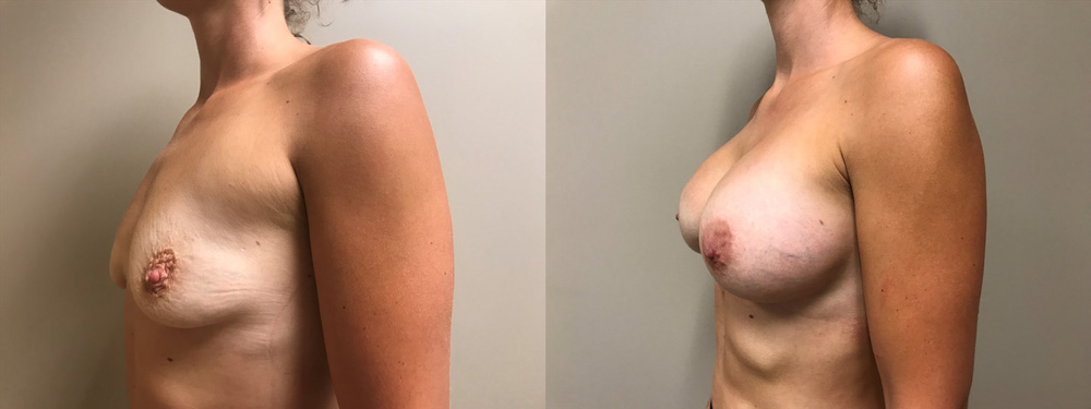 Breast Augmentation Patient 39 | Scottsdale Plastic Surgeon