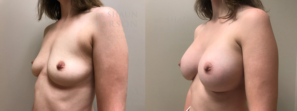 Breast Augmentation Patient 42 | Scottsdale Plastic Surgeon | Dr. Shaun Parson