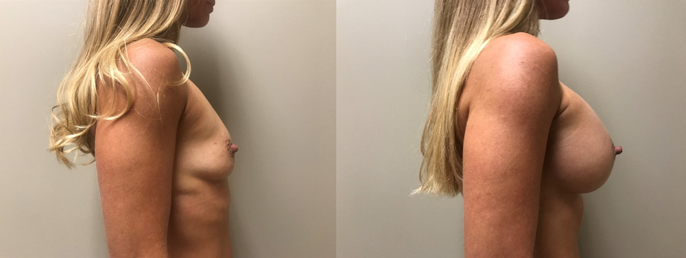 Breast Augmentation Patient 42 | Dr. Shaun Parson |Scottsdale