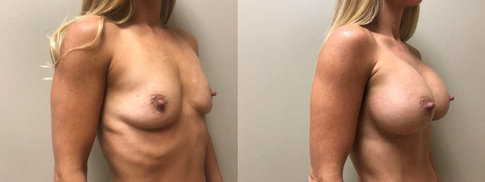 Breast Augmentation Patient 42 | Scottsdale Plastic Surgeon