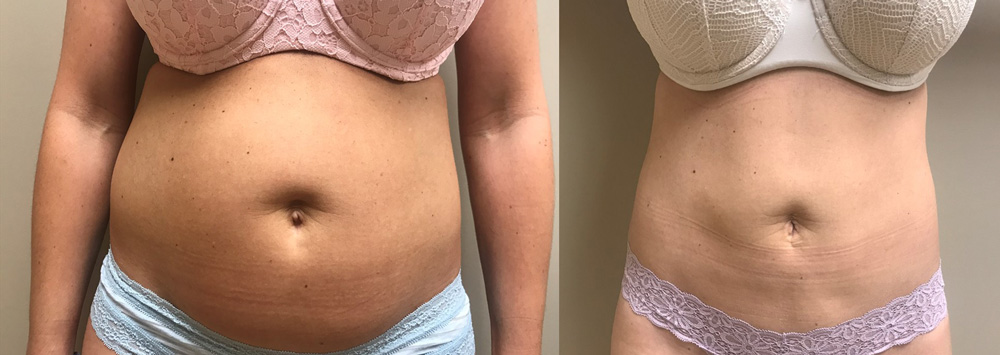 Scottsdale Liposuction Patient 18 | Dr. Shaun Parson