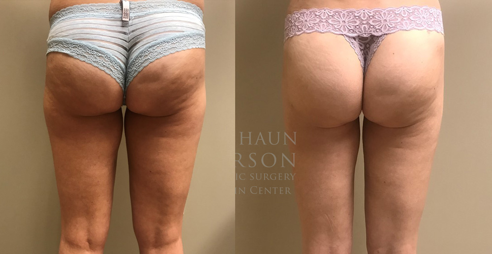 Scottsdale Liposuction Patient 18 | Dr. Shaun Parson