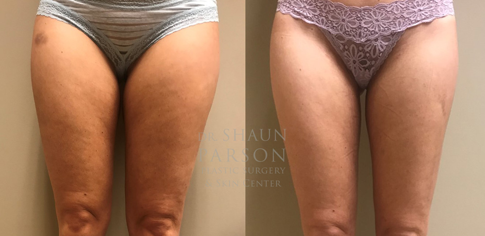 Scottsdale Liposuction Patient 18 | Dr. Shaun Parson